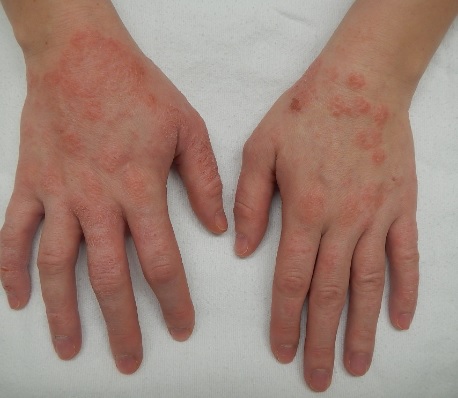 psoriasis and eczema